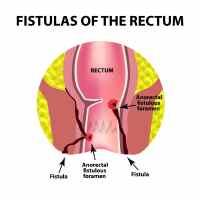 Piles, Fistula, Fissure
